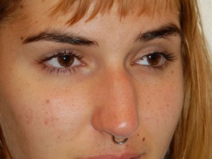 Nose Surgery Case 5646 Before Photo Nose Surgery