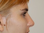 Nose Surgery