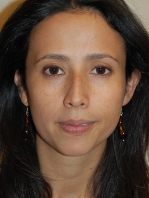 Nose Surgery Case 5663 Before Photo Nose Surgery
