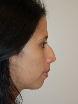 Nose Surgery