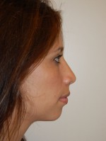 Nose Surgery