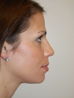 Nose Surgery