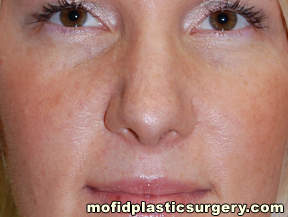 Nose Surgery Case 5682 After Photo Nose Surgery