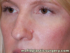 Nose Surgery Case 5682 Before Photo Nose Surgery
