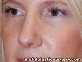 Nose Surgery Case 5682 After Photo Nose Surgery