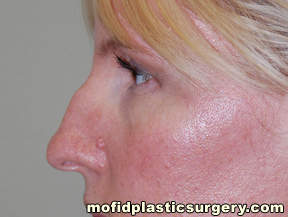 Nose Surgery Case 5682 Before Photo Nose Surgery