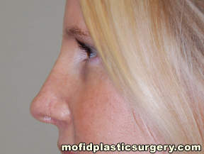 Nose Surgery Case 5682 After Photo Nose Surgery