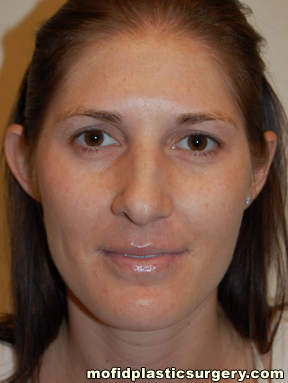 Nose Surgery Case 5690 Before Photo Nose Surgery