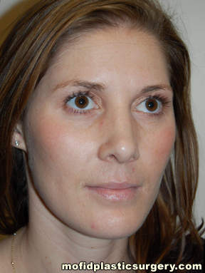 Nose Surgery Case 5690 After Photo Nose Surgery