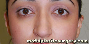 Nose Surgery Case 5698 Before Photo Nose Surgery