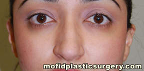 Nose Surgery