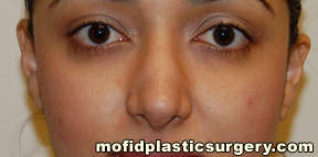 Nose Surgery Case 5698 After Photo Nose Surgery