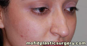 Nose Surgery Case 5698 Before Photo Nose Surgery