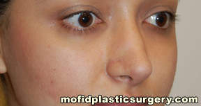 Nose Surgery Case 5698 After Photo Nose Surgery