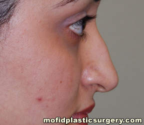 Nose Surgery Case 5698 Before Photo Nose Surgery