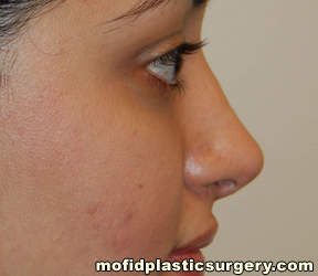 Nose Surgery Case 5698 After Photo Nose Surgery