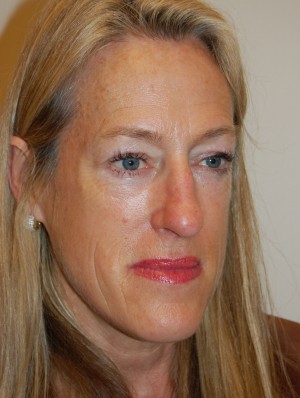 Nose Surgery Case 5708 Before Photo Nose Surgery