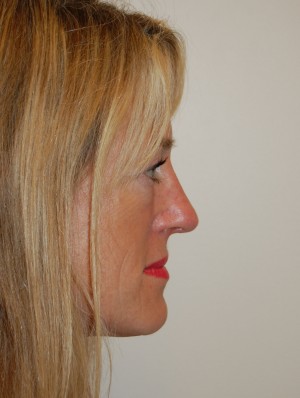 Nose Surgery Case 5708 After Photo Nose Surgery