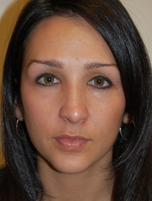 Nose Surgery Case 5714 After Photo Nose Surgery