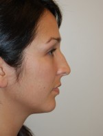 Nose Surgery