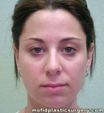 Nose Surgery