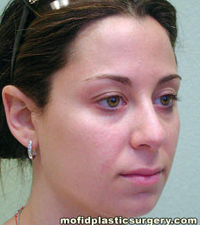 Nose Surgery Case 5724 Before Photo Nose Surgery