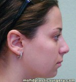 Nose Surgery