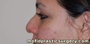 Nose Surgery Case 5736 Before Photo Nose Surgery