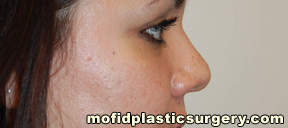 Nose Surgery Case 5736 After Photo Nose Surgery