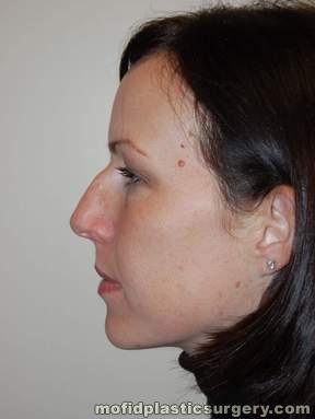 Nose Surgery Case 5746 Before Photo Nose Surgery