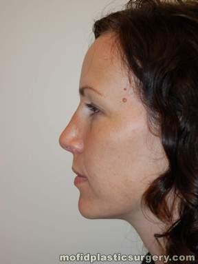Nose Surgery Case 5746 After Photo Nose Surgery