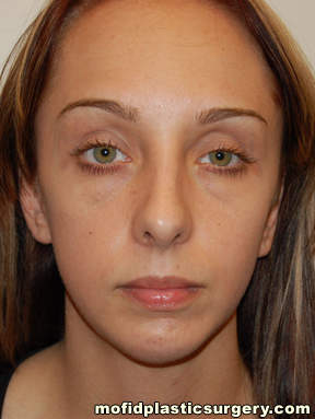 Nose Surgery Case 5754 After Photo Nose Surgery