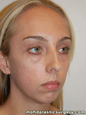Nose Surgery Case 5754 Before Photo Nose Surgery