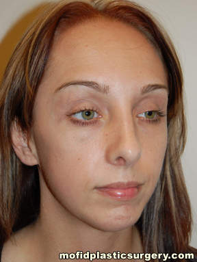 Nose Surgery Case 5754 After Photo Nose Surgery