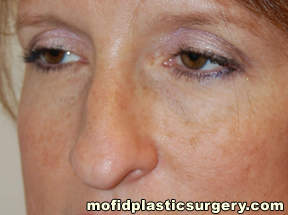 Nose Surgery