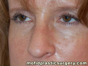 Nose Surgery Case 5762 After Photo Nose Surgery