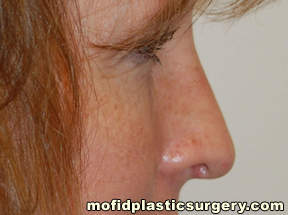 Nose Surgery Case 5762 After Photo Nose Surgery