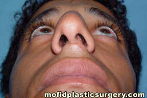 Nose Surgery