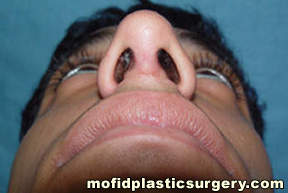 Nose Surgery