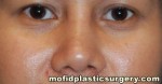 Nose Surgery