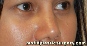Nose Surgery Case 5778 Before Photo Nose Surgery