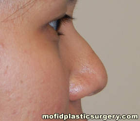 Nose Surgery Case 5778 Before Photo Nose Surgery