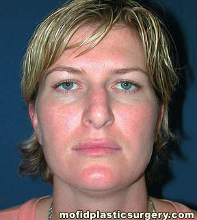 Nose Surgery Case 5794 Before Photo Nose Surgery