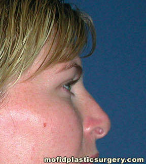 Nose Surgery Case 5794 Before Photo Nose Surgery