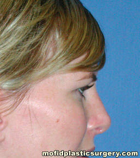 Nose Surgery Case 5794 After Photo Nose Surgery