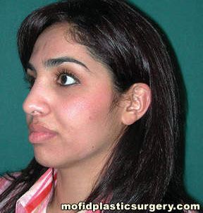 Nose Surgery Case 5802 After Photo Nose Surgery