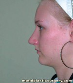 Nose Surgery