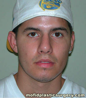 Nose Surgery Case 5816 After Photo Nose Surgery
