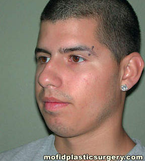 Nose Surgery Case 5816 Before Photo Nose Surgery