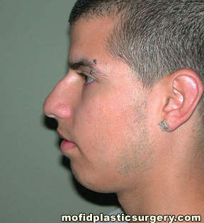 Nose Surgery Case 5816 Before Photo Nose Surgery